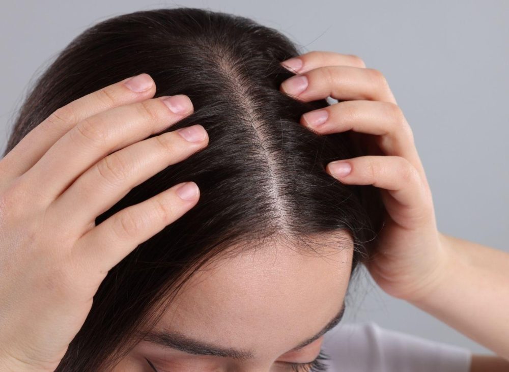 Scalp MTS microneedling treatment for hair thinning at Yeppeun Skin Clinic Jumeirah 2 Dubai