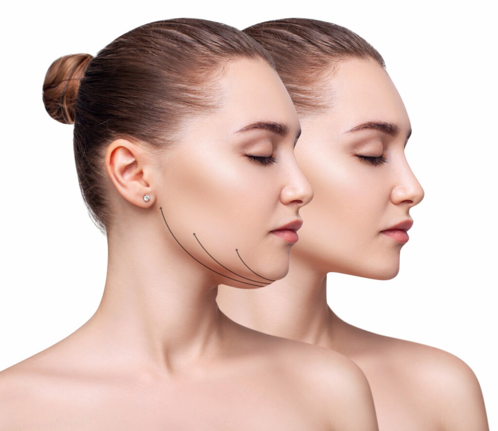 Side-by-side profile of a woman showing before-and-after chin contour improvement for Korean V-Lifting HIFU treatment