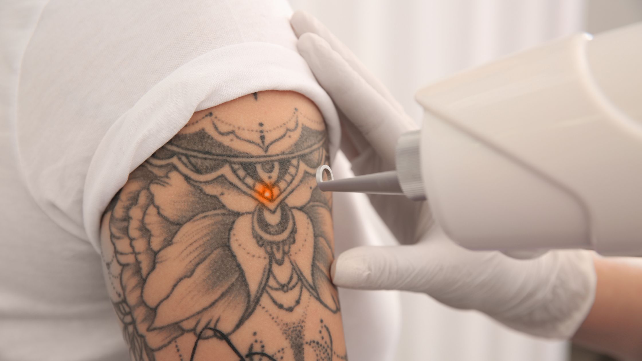 Laser Tattoo Removal at Yeppeun Skin Clinic Dubai