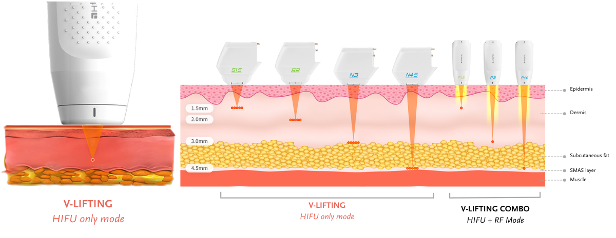 Diagram of V-Lifting HIFU handpiece delivering focused ultrasound energy to epidermis, dermis, subcutaneous fat and SMAS