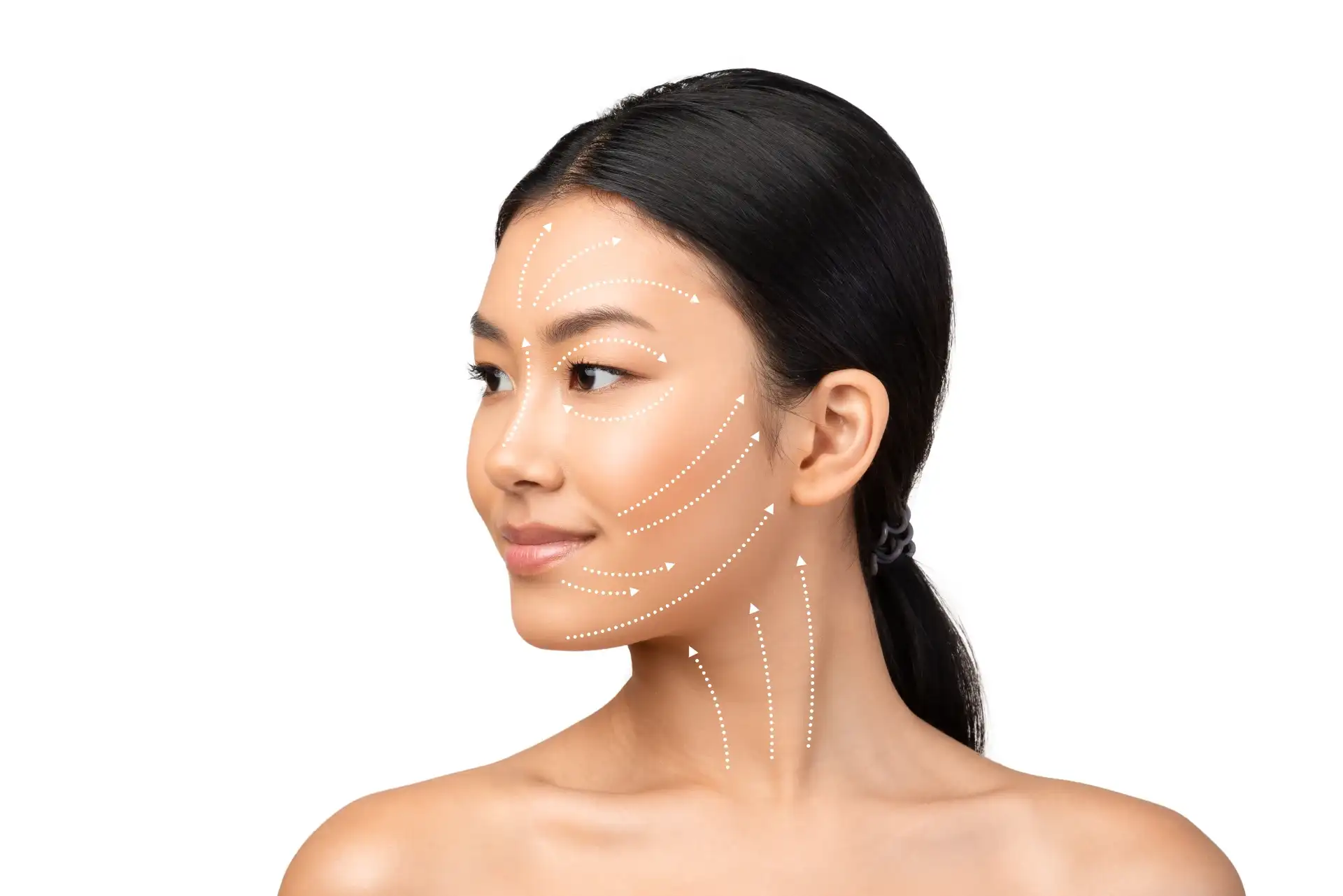 Profile of Asian woman with dotted arrow markings showing V-lifting HIFU treatment paths on face and neck