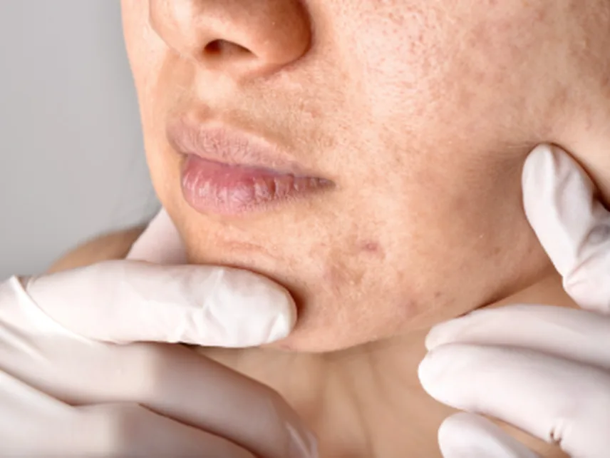 Treatments - Acne Scar Treatment at Yeppeun Skin Clinic Dubai
