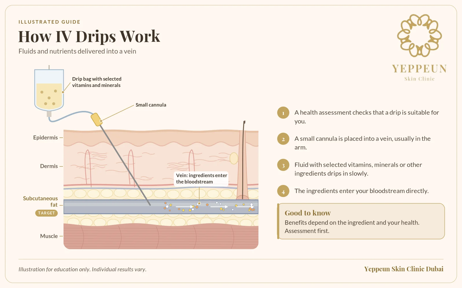 Vitamin infusion illustration of fluid passing through a small cannula into a vein - Yeppeun Skin Clinic Dubai
