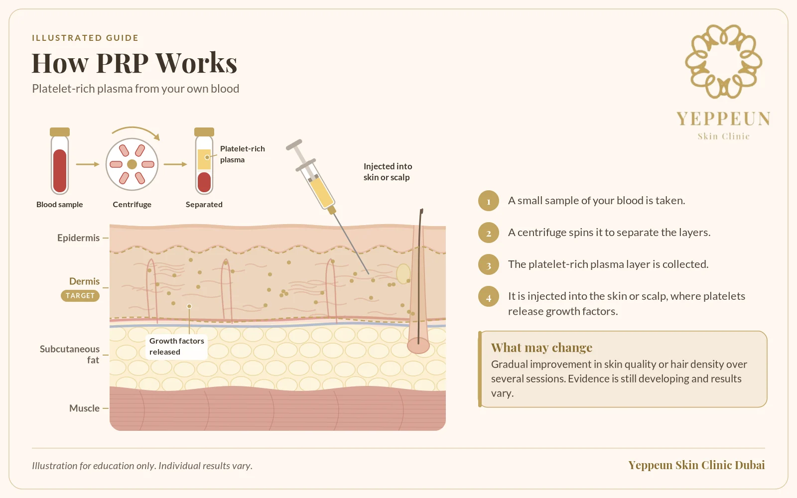 Platelet-rich plasma illustration from blood sample to centrifuge to injection - Yeppeun Skin Clinic Dubai